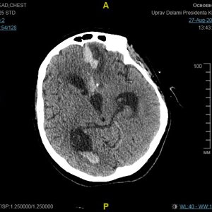 Клинический случай проведения второго этапа реабилитационного лечения пациентки повторного паренхиматозно-субарахноидально-вентрикулярного кровоизлияния в левой гемисфере головного мозга.