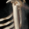 Остеосинтез перелома (хирургической) шейки плечевой кости