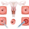 Конизация шейки матки аппаратом высокочастотной радиоволновой хирургии (Сургитрон)