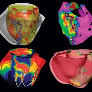 Использование персонализированных 3D-моделей виртуального сердца в лечении и диагностике аритмии