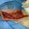Хиурургическая обработка раны или инфицированной ткани