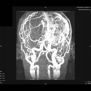  Врожденная гигантская артерио-венозная мальформация у пациента старше 20 лет. Клинический разбор.
