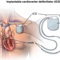 Хирургическое лечение жизнеугрожающих аритмий (имплантация кардиовертера-дефибриллятора)