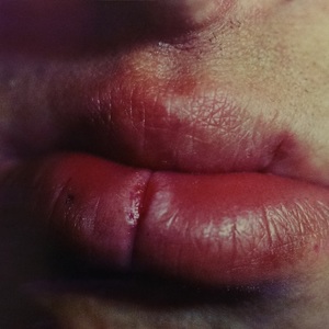 Хронические трещины губ