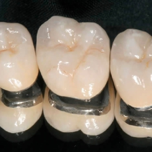 Зубные протезы из металлокерамики