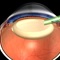 Ультразвуковая факоэмульсификация катаракты с имплантацией ИОЛ