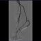 Ангиография артерий нижних конечностей