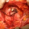 Эвисцерация органов малого таза