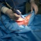 Хирургическая обработка раны (инфицированной ткани) методом ультразвуковой кавитации