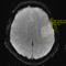 МРТ перфузия объемных образований головного мозга