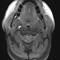 МРТ при подозрении на диссекцию магистральных артерий головного мозга 