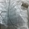 Имплантация кардиовертера/дефибриллятора