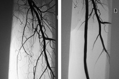 Ангиопластика и стентирование бедренных артерий 